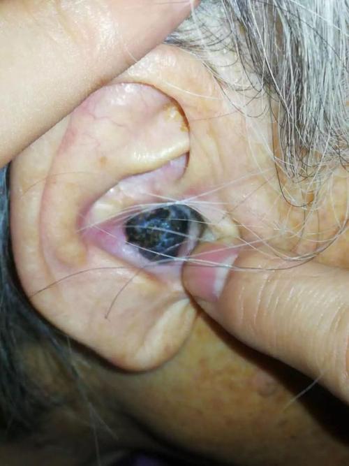可怕杭州一奶奶年轻时就爱掏耳朵结果里面长出了罕见的癌