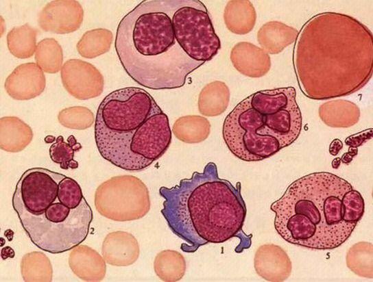 血小板减少2.过敏性紫癜3.缺铁性贫血4.白血病