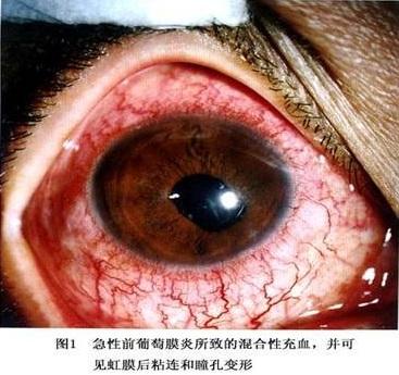 急性前葡萄膜炎由于葡萄膜炎初期的症状和红眼病很像,所以很多葡萄膜