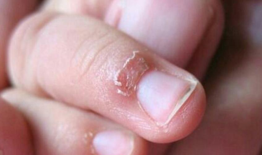 该如何处理宝宝手指倒刺?