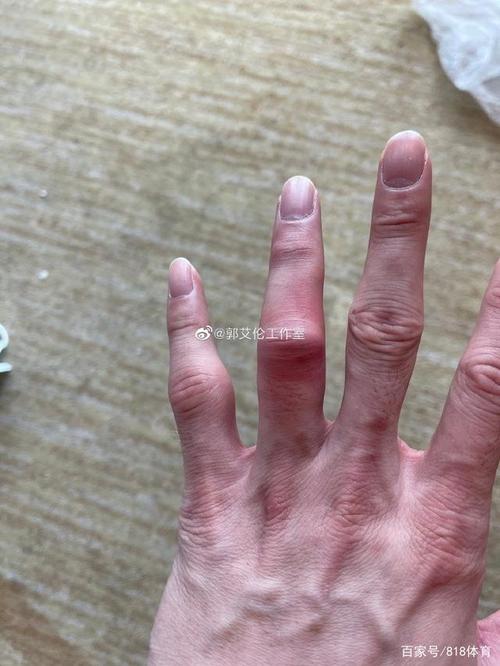 而郭艾伦的左手手指全部都肿胀了,特别是无名指红肿得厉害,应该是被
