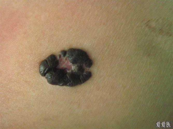 典型皮损 公布答案:结节性恶性黑色素瘤 - 皮肤及性传播疾病讨论版