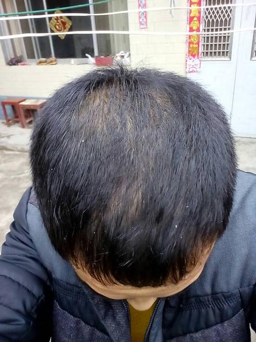 2015-04-19   展开全部 脂溢性脱发,少吃油腻,勤洗头,保持头发洁净