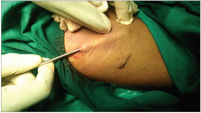 腋窝多汗症:肉毒素注射与皮下搔刮术