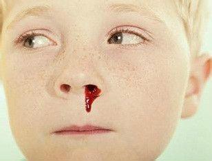 儿童经常鼻出血该怎么办?该如何治疗?