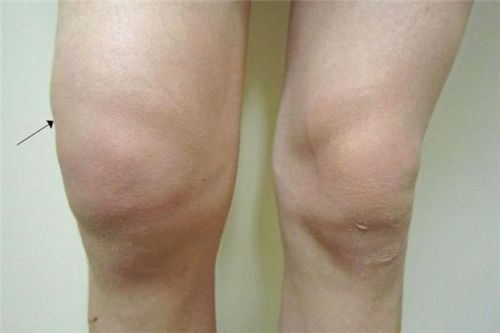 手腕,膝盖…等四肢的关节,造成关节内的黏膜发炎,增生,则容易产生膝盖