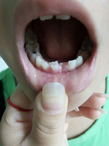 孩子第一次换牙,外面的牙齿还没掉,里面有长了一个牙齿.