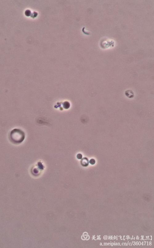非新鲜尿中的棘形红细胞