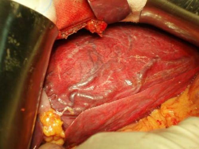 微导管肝动脉栓塞治疗肝脏巨大血管瘤