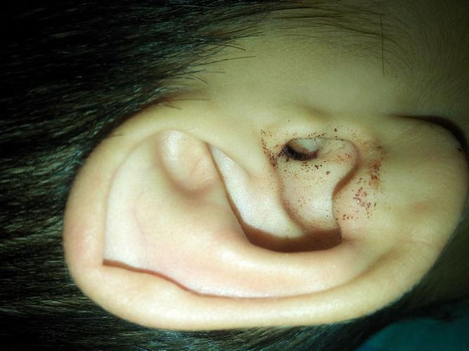 6岁耳朵被棉签弄出血检查过了没有伤到耳膜,睡了一夜血流到外面了,是