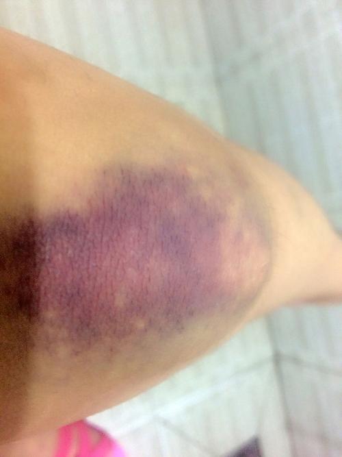 膝盖被磕到出现淤紫