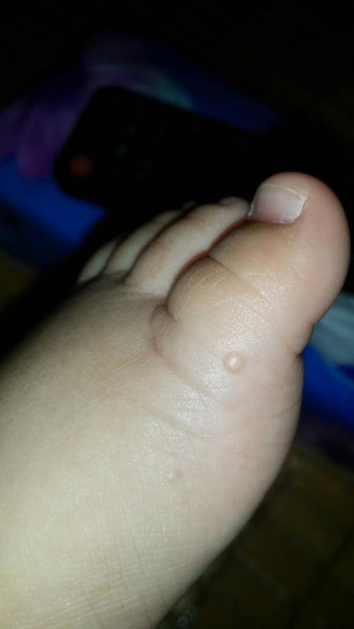 宝宝脚上长了两颗透明的水泡,没有发烧跟不舒服,这是疱疹还是水痘啊