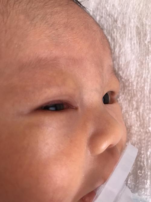 宝宝出生18天 已经持续一星期的眼睛流黄水 眼白有红血丝 去