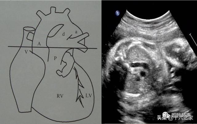 胎儿心脏动脉导管迂曲