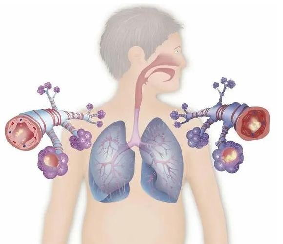 急性支气管炎大多是由于细菌,病毒感染,冷空气,粉尘刺激,或花粉,真菌