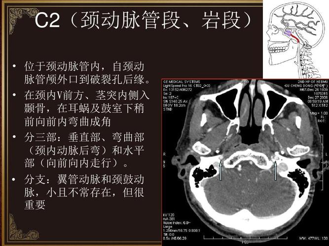 c2(颈动脉管段,岩段)   位于颈动脉管内,自颈动 脉管颅外口到破裂孔后