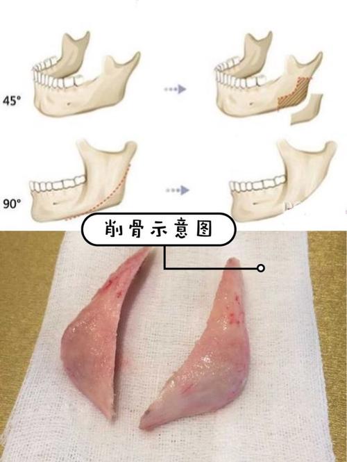 目前下颌角手术有三种术式