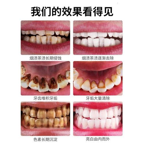 牙齿去牙斑净去结石洗牙粉变白牙非速效烟牙洗白