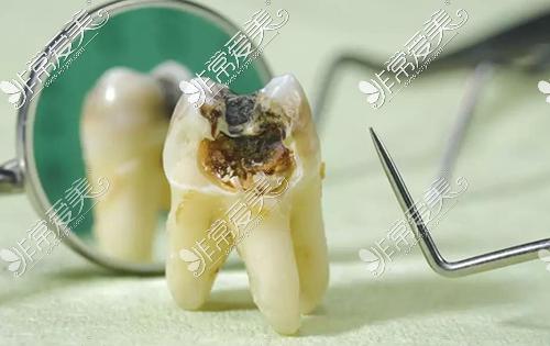 牙髓炎一直发展可引起牙髓的死亡,医学上称牙髓坏死.