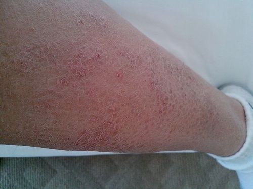 夏天起过红咀 小腿皮肤痒什么原因 小腿皮肤痒, 冬天小腿皮肤痒并起皮