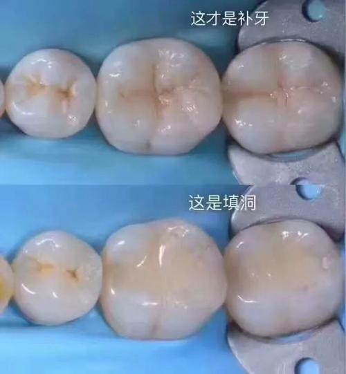 【实用】修补牙齿就是填洞吗?