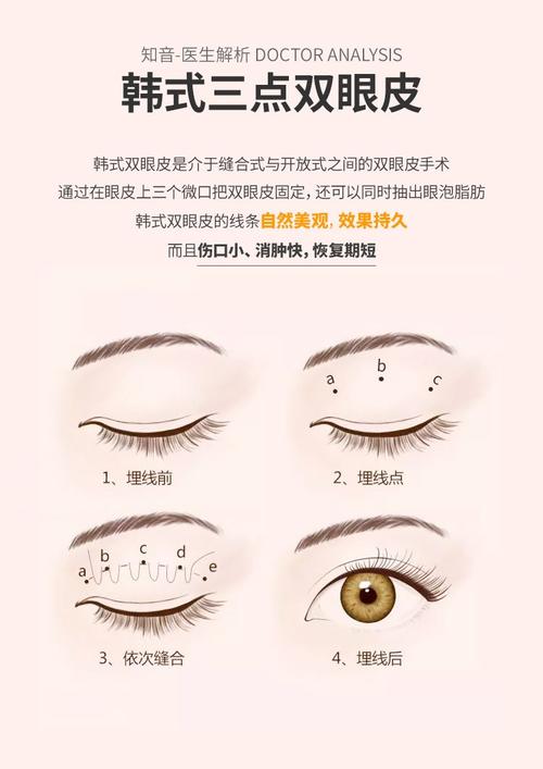 韩式三点双眼皮,定点双眼皮,开双眼皮手术,微创隐痕,眼部整形