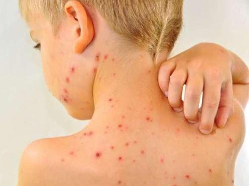 小孩得水痘会传染大人吗?