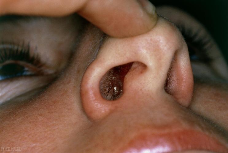 常见的有鼻息肉,鼻窦囊肿和鼻窦肿瘤.