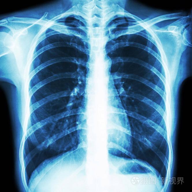 正常人的胸部照片-正版商用图片1hsz40-摄图新视界