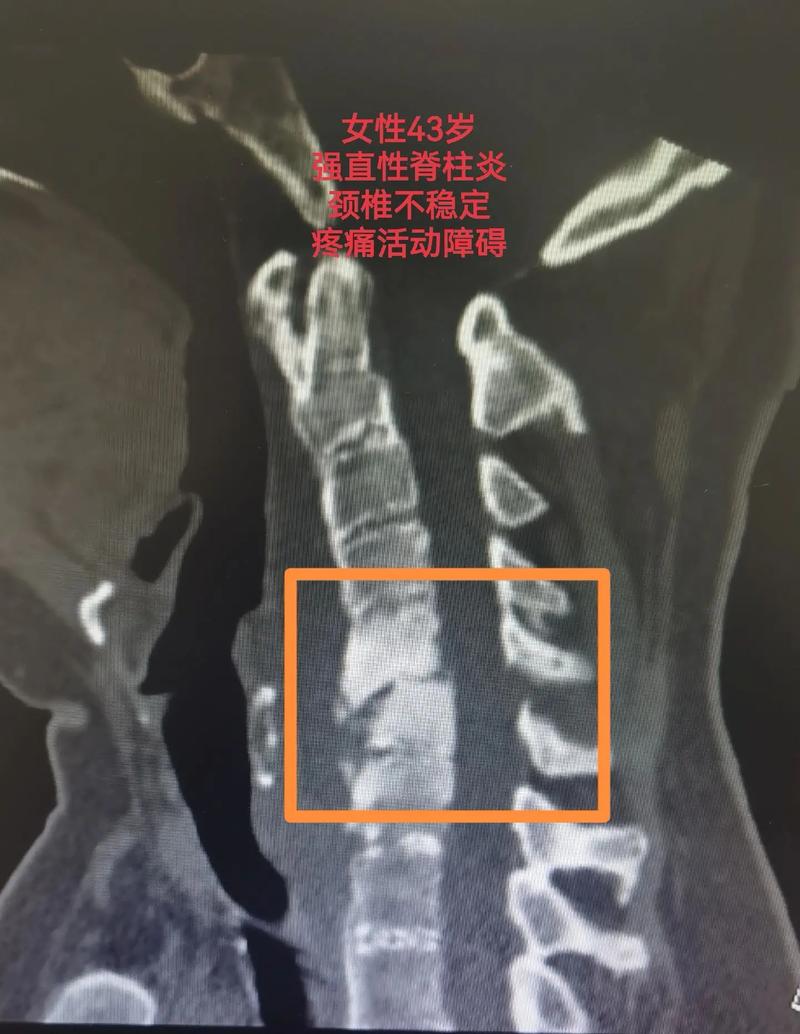 强直性脊柱炎后期脊柱僵硬且脆性增加.轻微外伤或 - 抖音