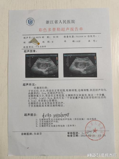 唐氏筛查是一项筛查胎儿化验单结果呈阳性也就是说受孕超过5周