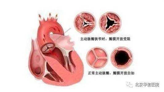 心脏瓣膜狭窄