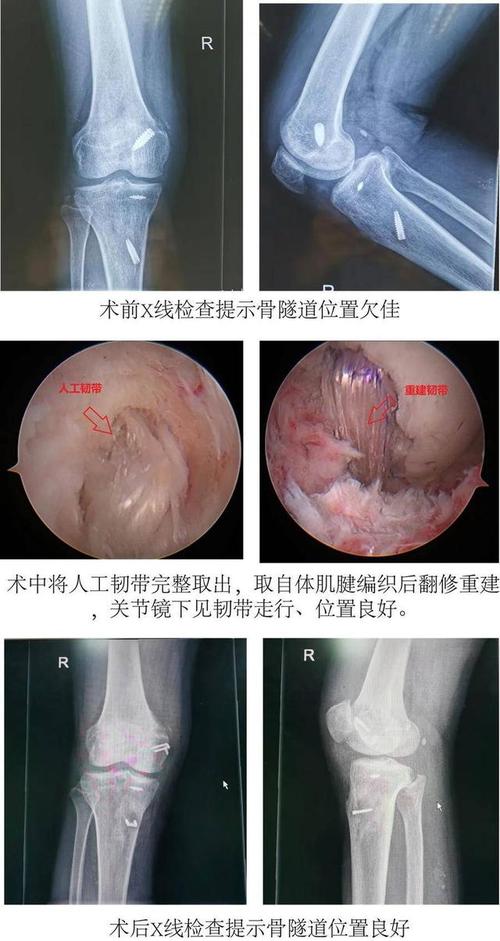 首先,由于张先生初次手术重建后交叉韧带时采用的移植物是lars人工