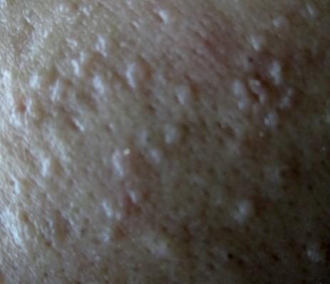 最近脸上长了很多白色透明的痘痘,请专家看看,下有图片.求解.