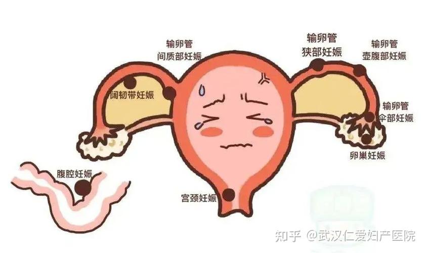 武汉妇产医院宫外孕太危险警惕出现这几点症状