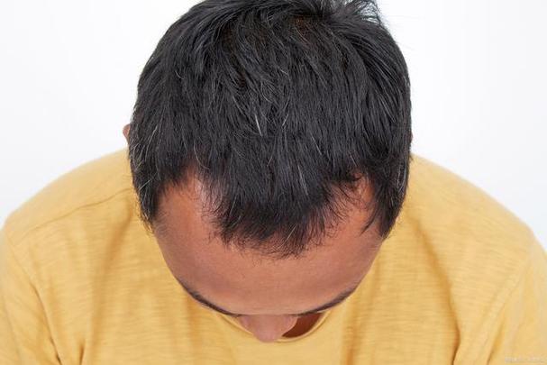高温烫发和染发是否会导致男性型脱发?如何保护头发免受损害?