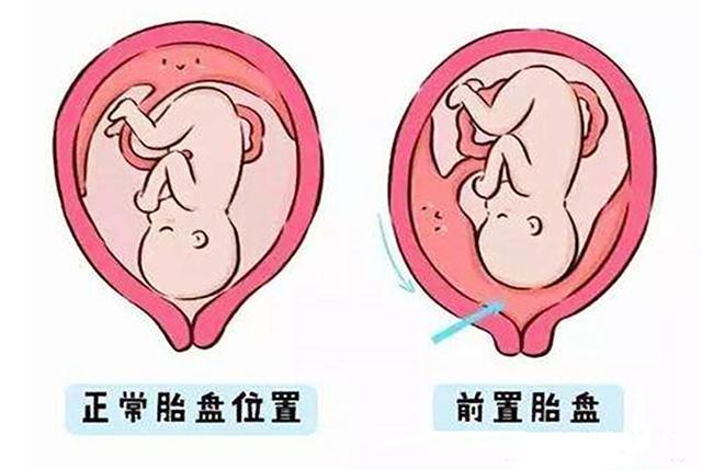 原创胎盘为什么会过低关于前置胎盘孕妈不得不提前了解的知识