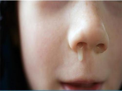 小孩流鼻涕最简单的处理方法小孩流鼻涕咳嗽怎么办