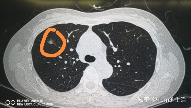 鉴于部分实性结节的恶性概率在3种结节中最高,因此其肺癌风险度评价