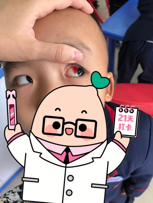 四岁儿子眼睛细菌感染|眼睛充血04