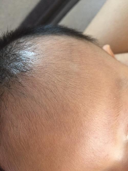 两个月的宝宝额头有小白块 是什么?