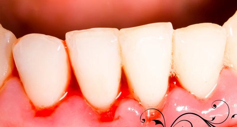 牙龈出血是癌症前兆吗
