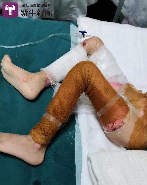 进行双手截肢手术后,这个年仅4岁的小男孩因气管切开,术后还不能说话
