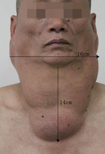 脂肪瘤形状特征
