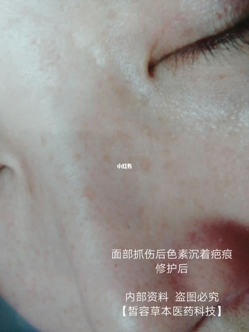 面部抓伤后色素沉着疤痕 修护前后效果对比_疤痕_郑州高新企业加速器