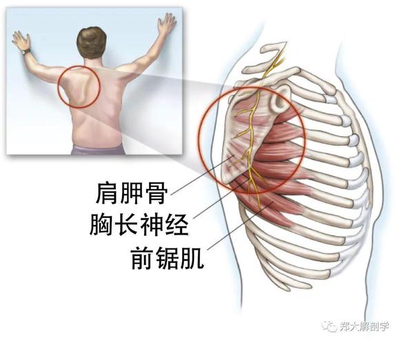 胸长神经损伤可能导致出现翼状肩.