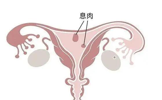子宫内膜息肉奇迹般消失了其实对于小的,无症状的子宫内膜息肉,可暂时