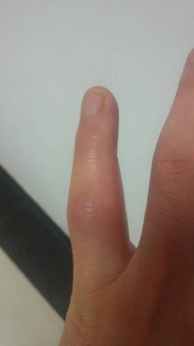 左手小拇指关节扭伤!刚开始不是太疼痛!这两天疼痛肿!