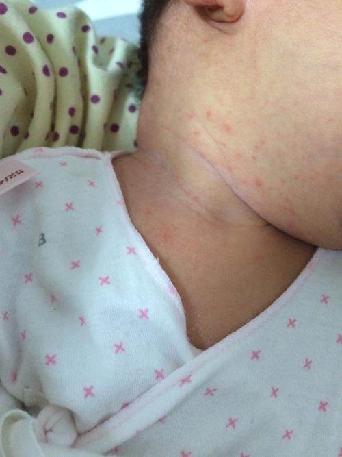宝宝出生14天脖子上起了好多红点,是不是湿疹?求教专家