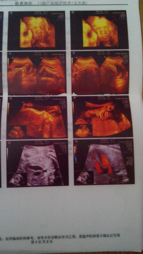 孕26周四维彩超,宝妈们看下是男宝还是女宝.